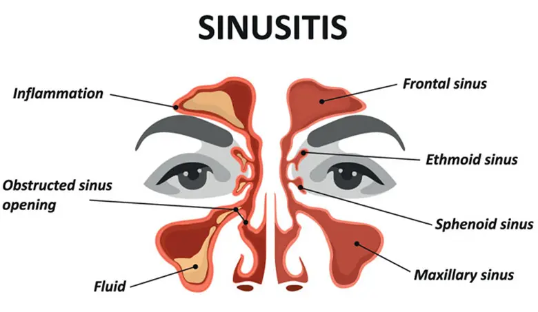 telehealth sinus treatment online